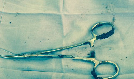 Doctors Remove Scissors From Mans Abdomen After 18 Years